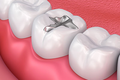 Ocean Township Amalgam Fillings