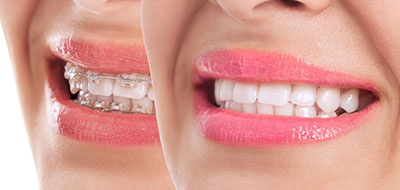 braces in Ocean Township