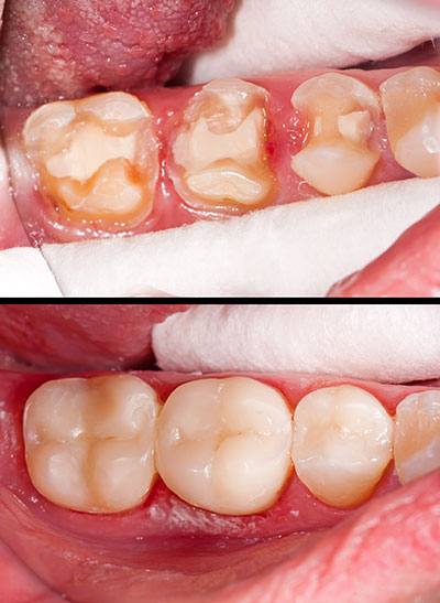 Ocean Township Composite Fillings