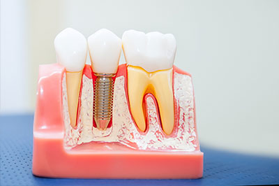 Dental implants in Ocean Township