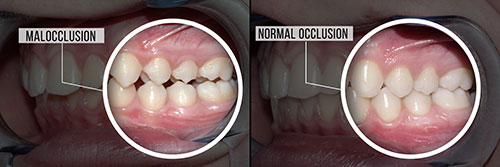 Ocean Township Malocclusion