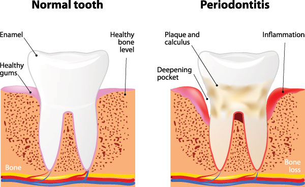 Periodontal Disease in Ocean Township