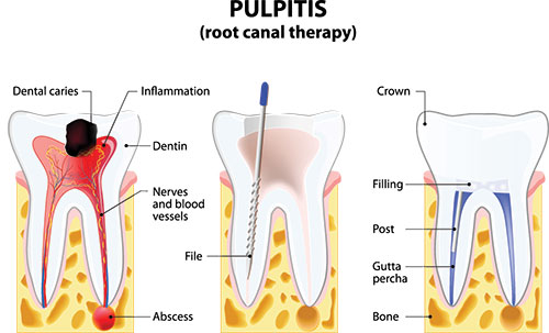 Root Canal in Ocean Township