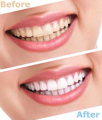 Ocean Township teeth whitening