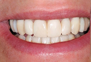 Dental Implants in Ocean Township