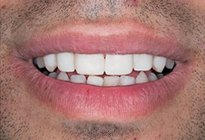 Veneers in Ocean Township