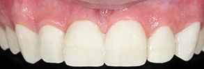 Ocean Township Before and After Dental Braces