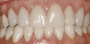 Before and After Dental Crowns in Ocean Township