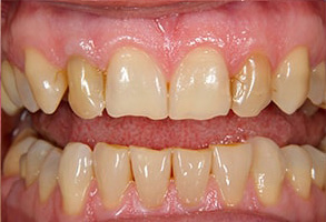 Ocean Township Teeth Whitening